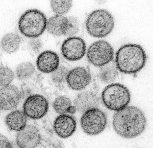 Confirman Primer Caso de Mpox en Baja California Sur: Paciente en Resguardo Domiciliario