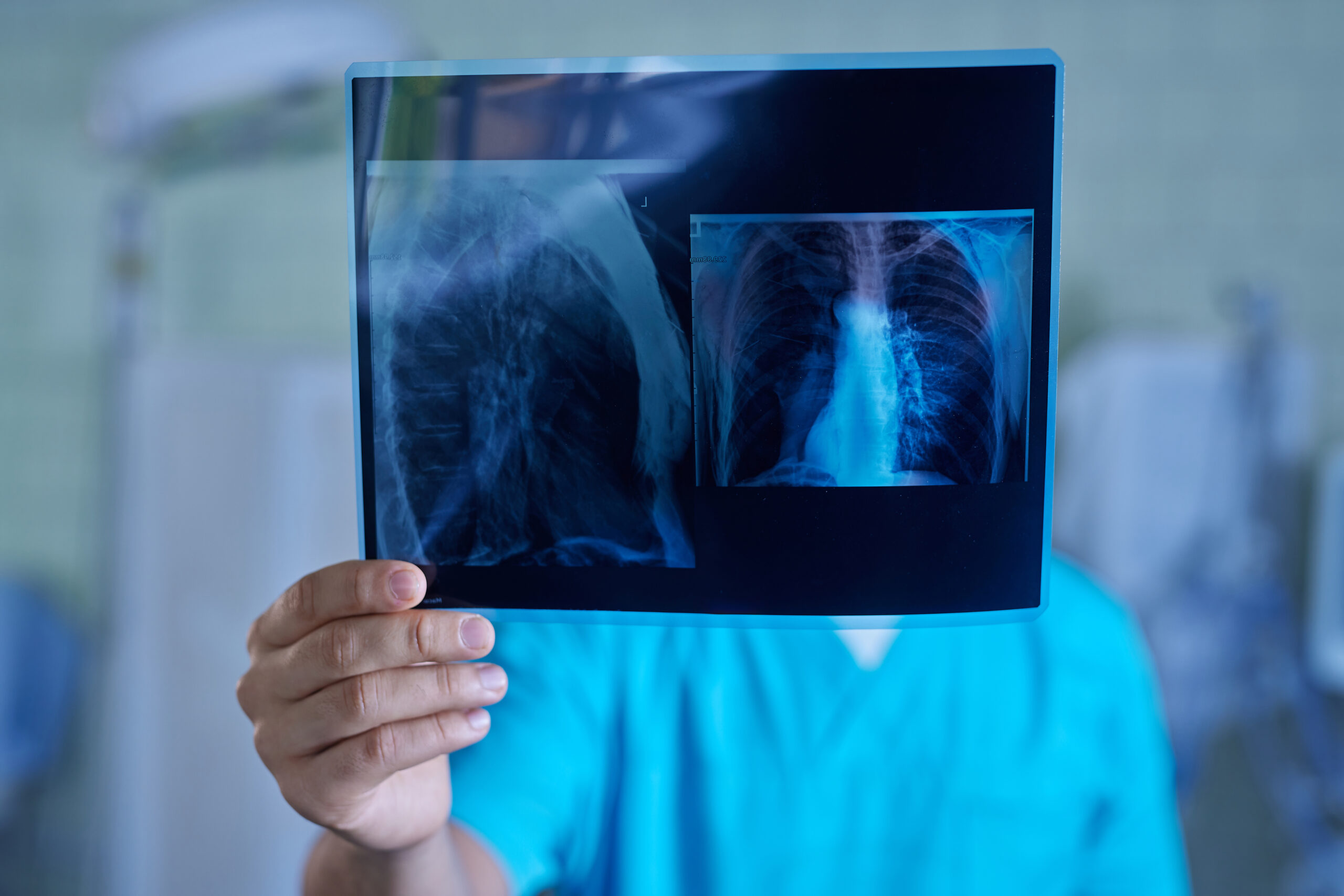¡Alerta de salud en San Diego! Podrias haber estado expuesto a Tuberculosis